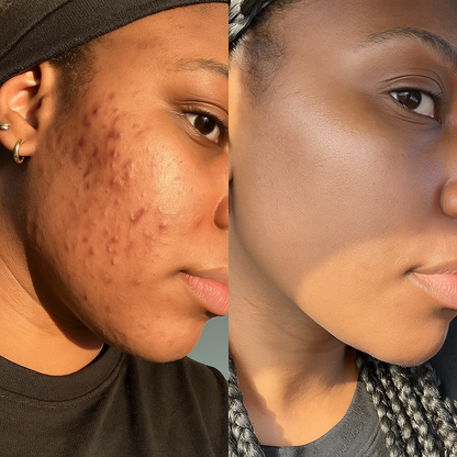 KojiPure: Viral Turmeric & Kojic Acid Cleansing Pads